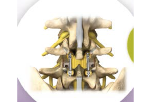 Learning Library: Maximum Access Surgery Posterior Lumbar Interbody Fusion (MAS® PLIF): What is it and is it right for me?