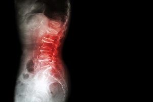 Degenerative Spondylolisthesis | What Is It and How It Is Treated